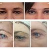 PLASMA — Cold plasma cosmetology device
