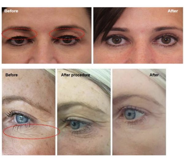 PLASMA — Cold plasma cosmetology device