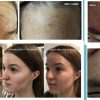 PLASMA — Cold plasma cosmetology device