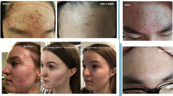 PLASMA — Cold plasma cosmetology device